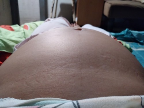 ห้ามนอนหงาย