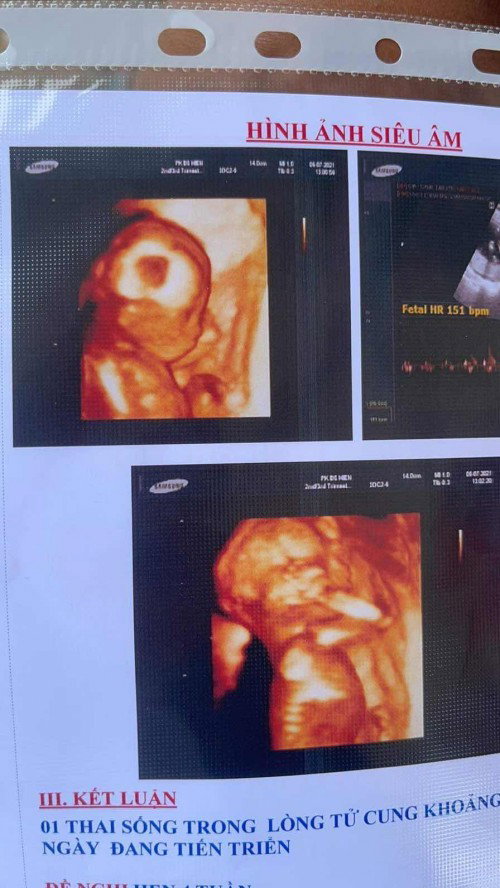 Bầu 17w baby girl