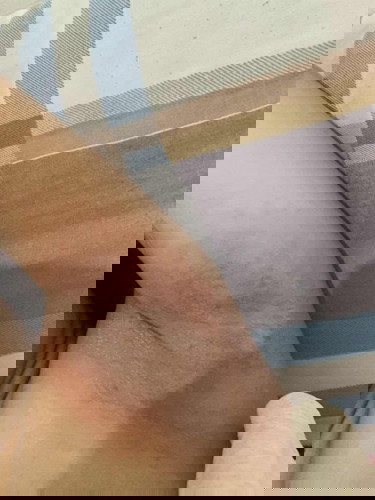 Rashes underarm
