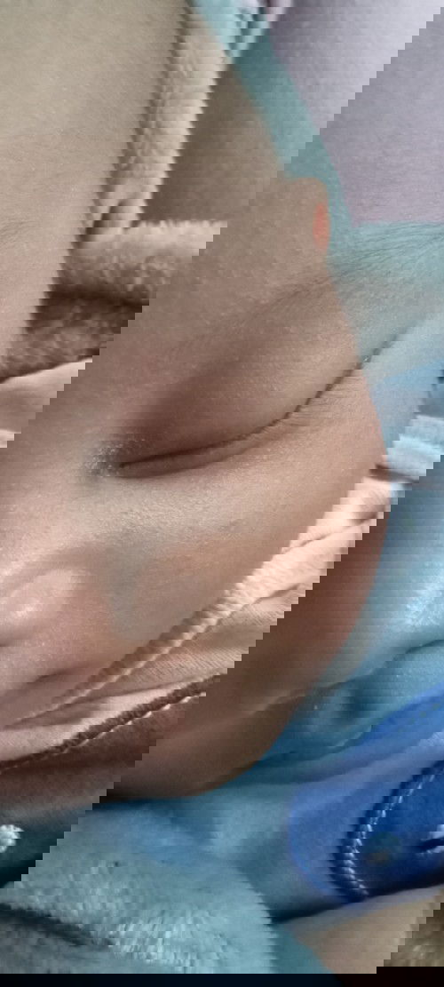 Biang keringat/ kena asi