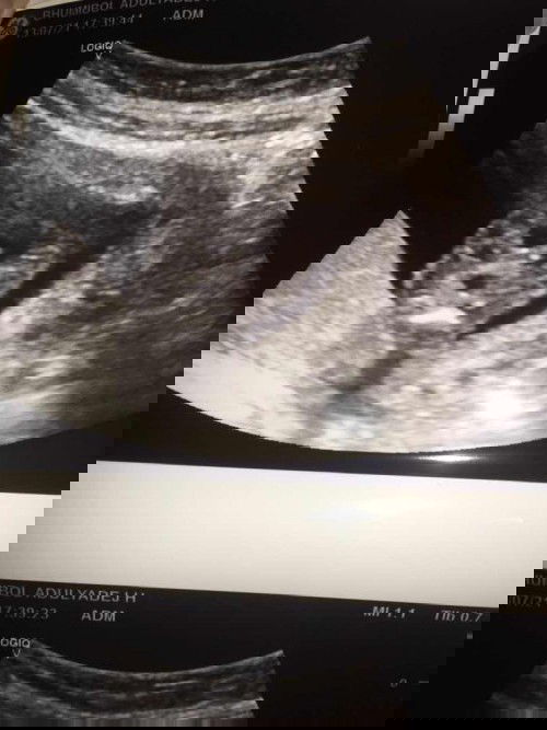 วันนี้ครบ 17wพอดีค่ะ