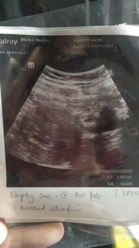 Kantung leper bila scan 8minggu.ada kemungkinan X dia Akan normal.doc dah cakap kandungan X menjadi.doc suruh cuci..tp saya nak tunggu dulu dlm 2minggu.harap Ada keajaiban.