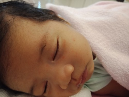 ลูกมีผื่นเเดงขึ้นที่ใบหน้า