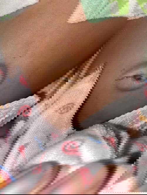 สะดือลูกปกติมั้ย