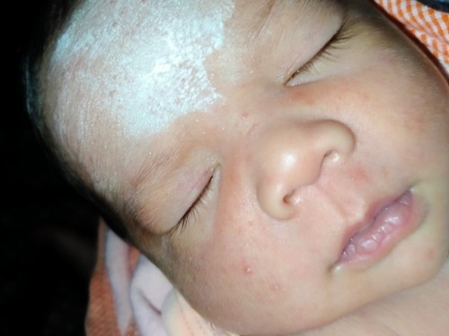 ตุ่มแบบนัคืออะไรค่ะ น้องงอแงมากเลยค่ะตั้งแต่ตุ่มแบบนี้ขึ้น