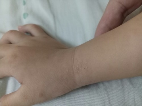 Bé nổi mụn tay như hình, sần nhẹ, ko ngứa nhiều, ko triệu chứng lạ, moms cho chút kn, e cám ơn