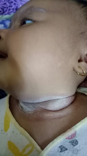 Ruam pada leher bayi paling ampuh pakek bedak/krim apa ya bun? Gk tega sampe merah2 lehernya