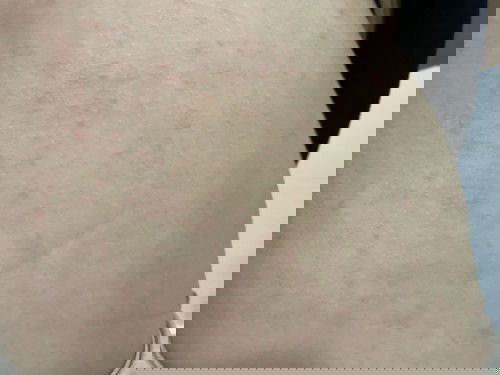 แม่ๆบ้านไหนมีผด ผื่น ขึ้นบ้างคะ