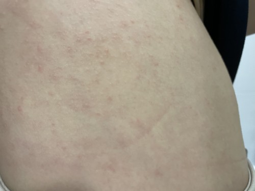 แม่ๆบ้านไหนมีผด ผื่น ขึ้นบ้างคะ