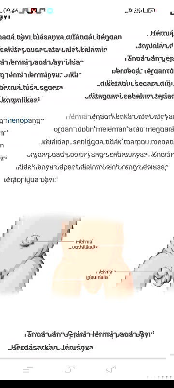 Hernia pada bayi lrlaki