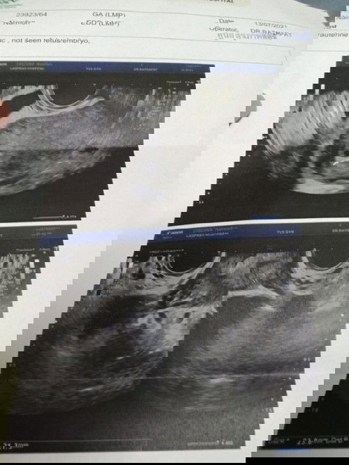 ท้อง5วีคมีเลือดออกเวลาฉี่