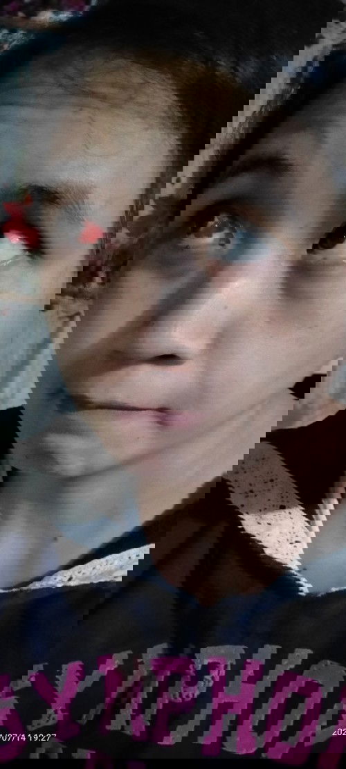 Hi momshies, sino po nakaexperience ng ganito sa mata habang buntis? Ano po pwedeng gamot?