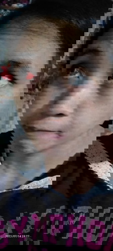 Hi momshies, sino po nakaexperience ng ganito sa mata habang buntis? Ano po pwedeng gamot?