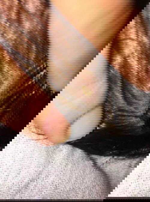 Sugat at namumuong nana sa ulo