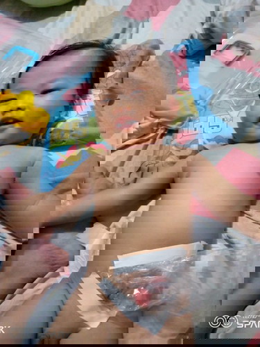 im imferporate annus baby with conginital cataract both eyes ..