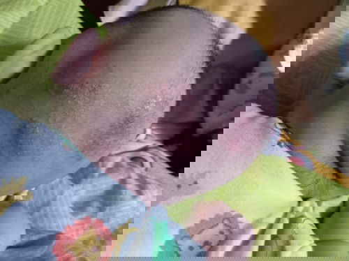 Masalah kulit kepala bayi