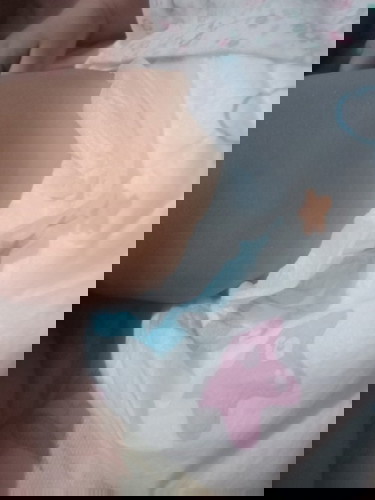 Uneven skintone