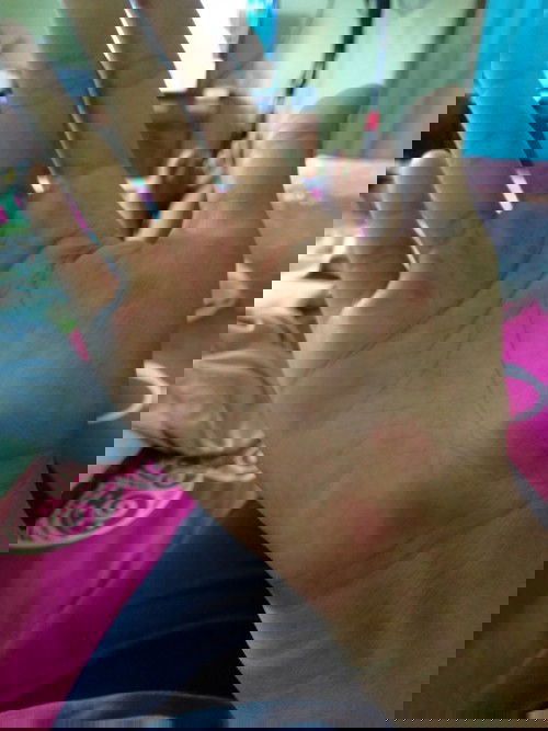 Gatal di telapak tangan dan kaki