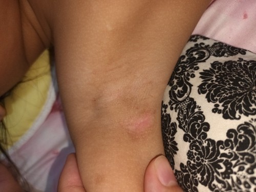 Is this heat rash ?
