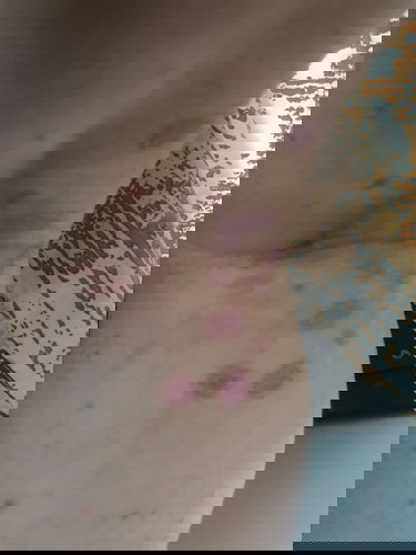 ตั้งครรภ์ 8 เดือน เพิ่งจะมีอาการคัน แถมเป็นเชื้อราตรงข้อพับ