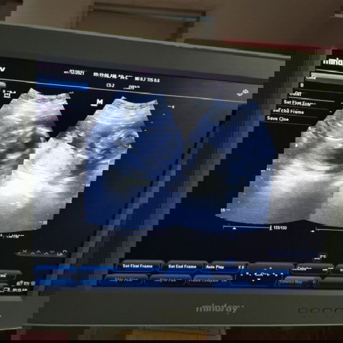 laging tumitigas ang tiyan 18weeks pregnant normal lang ba to?