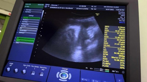 อายุครรภ์ตามอัลตราซาวด์เขาดูตรงไหนคะ ?