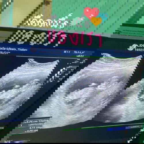 13W มีคุณแม่บ้านไหนที่อายุครรภ์เท่านี้แต่รู้เพศลูกบ้างแล้วคะ บ้านนี้หมอบอกว่าน้องยังตัวเล็กอวัยวะก็มองไม่ออกคะ รอลุ้นดูเดือนหน้าว่าน้องเปิดให้ดูไหม