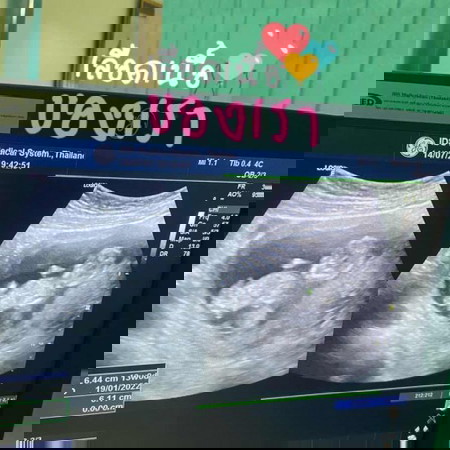 13W มีคุณแม่บ้านไหนที่อายุครรภ์เท่านี้แต่รู้เพศลูกบ้างแล้วคะ บ้านนี้หมอบอกว่าน้องยังตัวเล็กอวัยวะก็มองไม่ออกคะ รอลุ้นดูเดือนหน้าว่าน้องเปิดให้ดูไหม