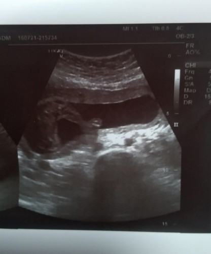 16+3สัปดาห์ เพศลูกดูออกหรือยังคะ