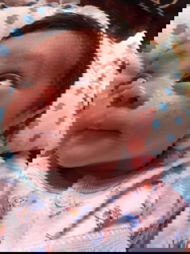 ลูกหน้าเป็นสิวค่ะลูกพึ่ง22วัน