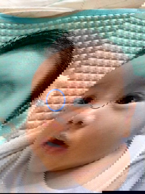 Benjolan di atas hidung bayi