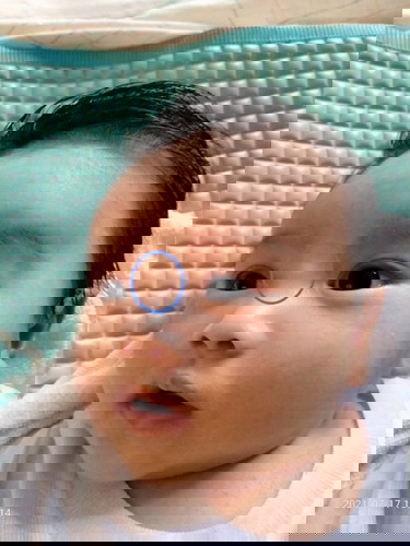 Benjolan di atas hidung bayi