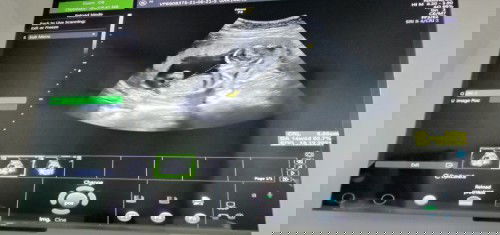 แม่บ้านไหนเป็นบ้างคะ ท้อง2 อายุครรภ์18week เหนื่อยหอบง่าย เวลาหายใจเข้าจุกอยู่ที่อก