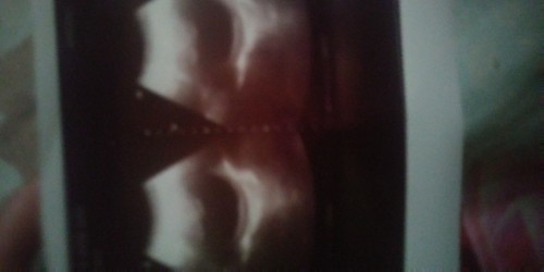 Usg saya perkirakan dokter 5 bulan janin/bayi dan dinyatakan bo anjuran kuret.. Setelah saya ingat2