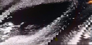 การตั้งครรภ์