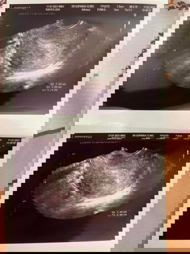 ท้อง 6 week แต่พอไปซาวไม่เจอน้องมีแม่ๆท่านไหนเคยเจอแบบนี้บ้างไหมคะกังวลมากเลยค่ะตรวจเลือดก็ขึ้นว่าตั้งท้องตรวจฉี่ก็ขึ้น 2 ขีดแบบนี้ปกติอยู่ไหมคะ