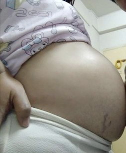 เส้นเลือดที่ท้อง