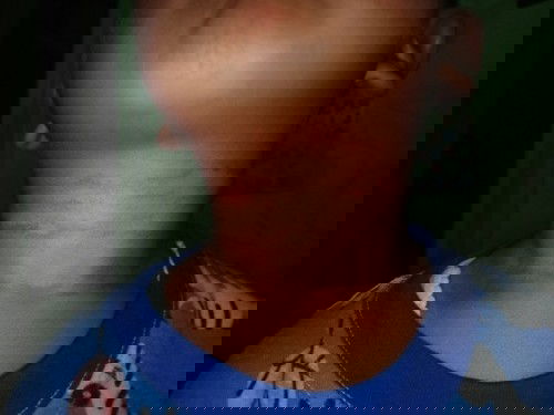 Ruam beruntusa  kaki dan tangan