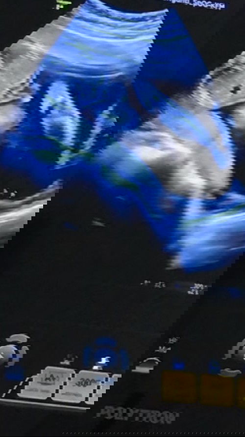 Hamil Anak Pertama & LDM