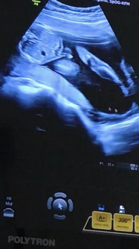 Hamil Anak Pertama & LDM