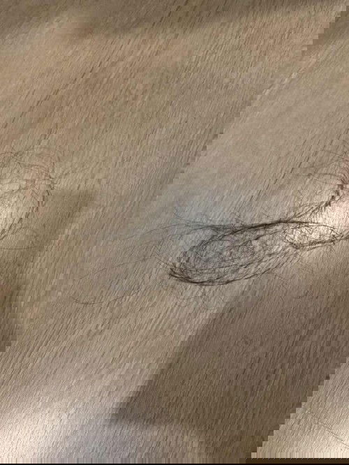 สอบถามแม่ๆ หลังคลอดน้องผมร่วงเยอะขนาดไหนบ้าง ส่วนตัวคลอดน้องได้ 4 เดือนกว่าผมเพิ่งเริ่มร่วงตอน น้อง 3 เดือน พอเข้าเดือน 4 ผมแม่ร่วงหนักมาก