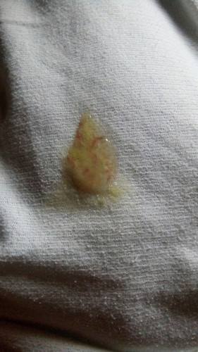 BAB berdarah dan berlendir