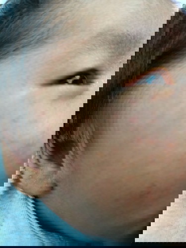 น้องมีผื่นแบบนี้