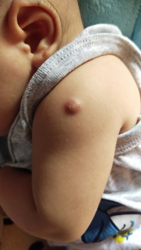 ฉีดวัคซีนเข็มแรก เค้าเรียกว่าปลูกฝีเป็นแบบนี้ไหมคะ?