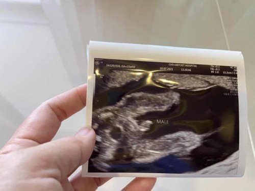 อัลตร้าซาวด์ อายุครรภ์ 5 เดือน
