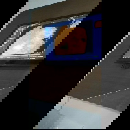 USG 21 Minggu, janin terlilit tali pusat 1 kali