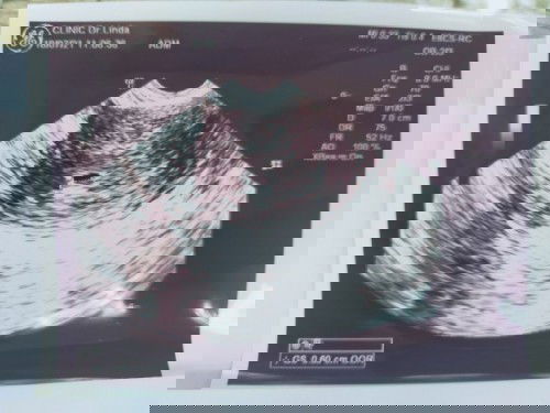 อายุครรภ์ 4w4d (นับตามแอพ) ไปอัลต้าซาวด์เจอแต่ถุงตั้งครรภ์ รบกวนแม่ๆช่วยดูผลหน่อยค่ะ