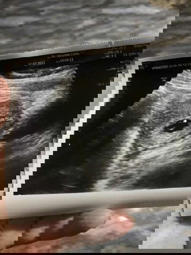 #ท้องลม ภาวะไข่ฝ่อ