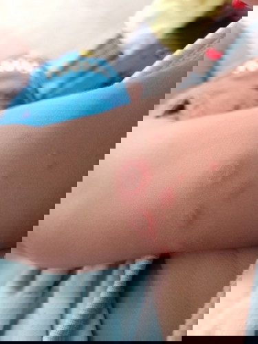 มีแม่ๆคนไหนรู้ไหมคะว่าเกิดจากอะไร ทางบ้านก็บอกแมงไฟ แต่ลูกไม่ร้องอะไรเลยค่ะ เป็นมา2วันแล้วค่ะ