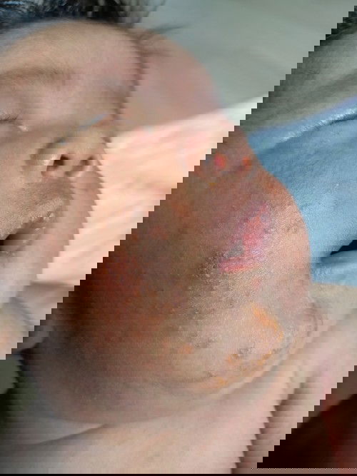 น้องเป็นผื่นแบบนี้ทำใงดีค้ะ